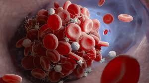 Mieux comprendre la thrombose