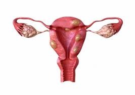 Les causes des polypes utérins