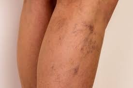 Traitement indien des thromboses