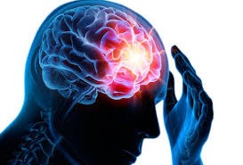 Epilepsie et AVC
